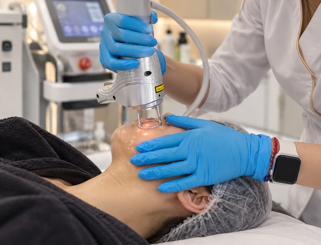 CO₂ laser handpiece being guided over a client's face