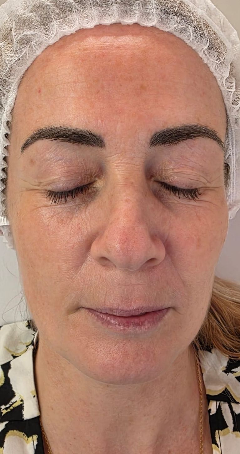 After treatment